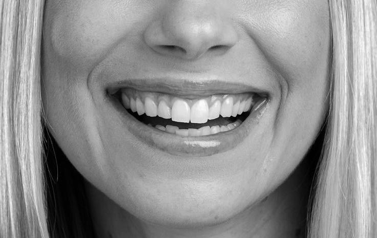 Full Face smile design Снимка 8